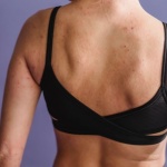 Dites adieu à la peau granuleuse : astuces et soins efficaces pour atténuer la kératose pilaire